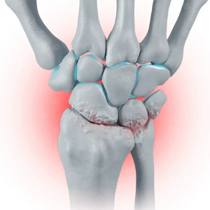 Arthritis